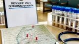 Mississippi health officials confirm five cyclosporiasis cases, including one on Coast